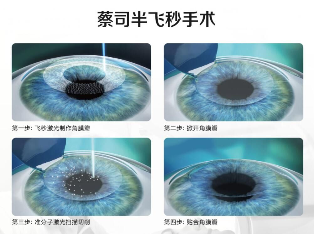 TransPRK手術(shù)與蔡司全飛秒手術(shù)、半飛秒手術(shù)有什么區(qū)別?
