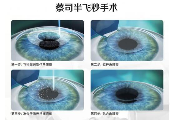準(zhǔn)分子激光手術(shù)到底是怎么治 愈你的眼睛的？