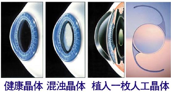 超聲乳化手術(shù)白內(nèi)障危險(xiǎn)嗎？
