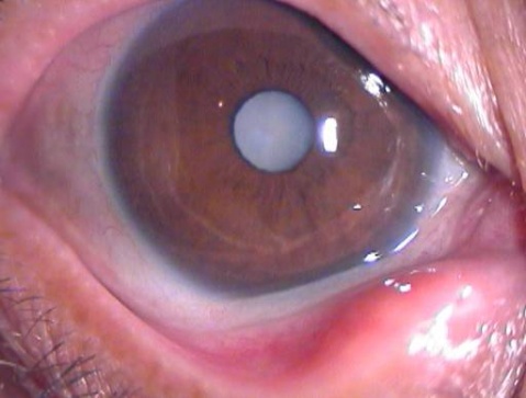 為什么會(huì)得白內(nèi)障眼??？