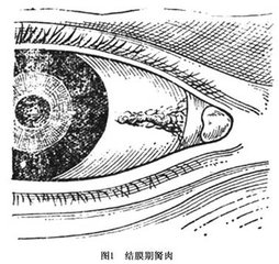 黑眼睛前面多長出一塊白肉怎么辦？