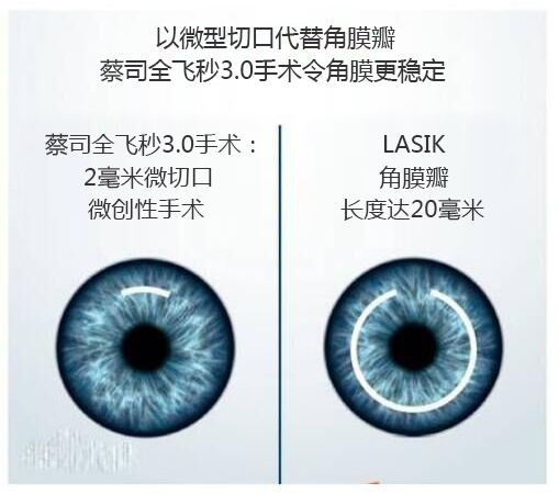 做完近視手術(shù)要休息多長時間？需要住院嗎？