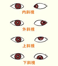 看看兒童斜視眼病怎么預(yù)防？