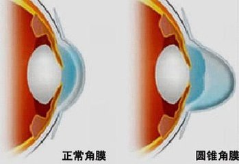 圓錐角膜，哪種角膜移植術(shù)好？