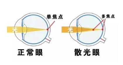 近視和散光，手術(shù)能同時(shí)矯正嗎？