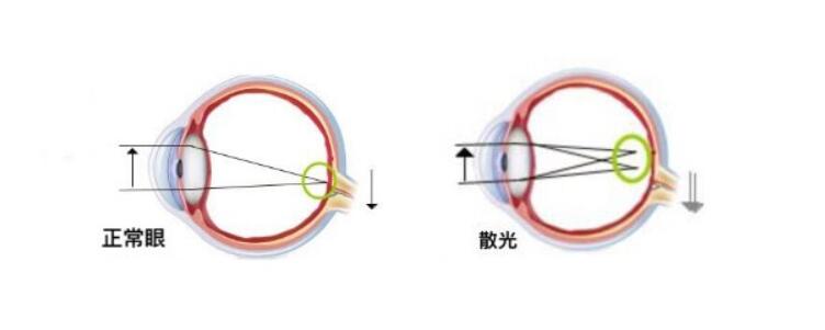 高度散光加近視可以做手術(shù)嗎？